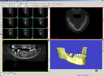 ＳＴＥＰ２　診断、ご説明、治療計画、口腔内チェック
